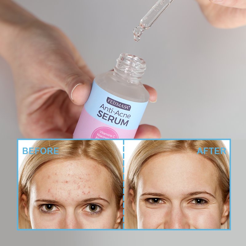 Sérum visage de traitement anti-acné et boutons - 3